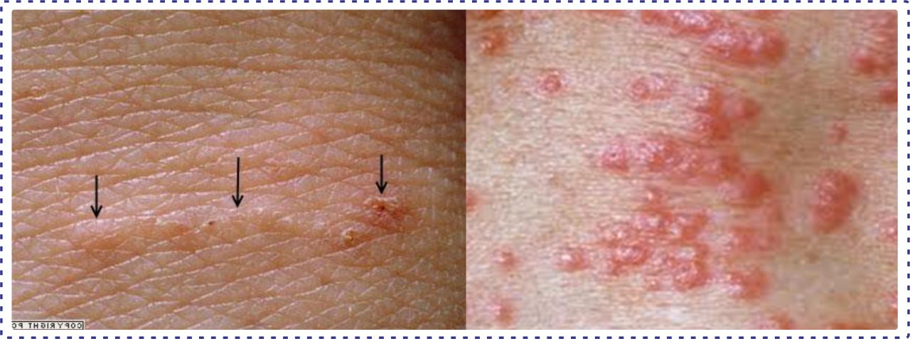 Scabies Adalah Penyakit Homecare