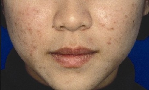 Nih Penyebab Munculnya Jerawat Muda di Muka Ngana