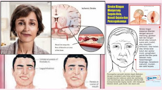 Cara cepat untuk menyembuhkan penyakit stroke pada pria dan wanita tanpa operasi