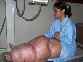 penyakit langka yang ada didunia..... tarraaaaa.......