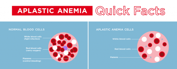 6 Jenis Penyakit Anemia yang Umum Terjadi