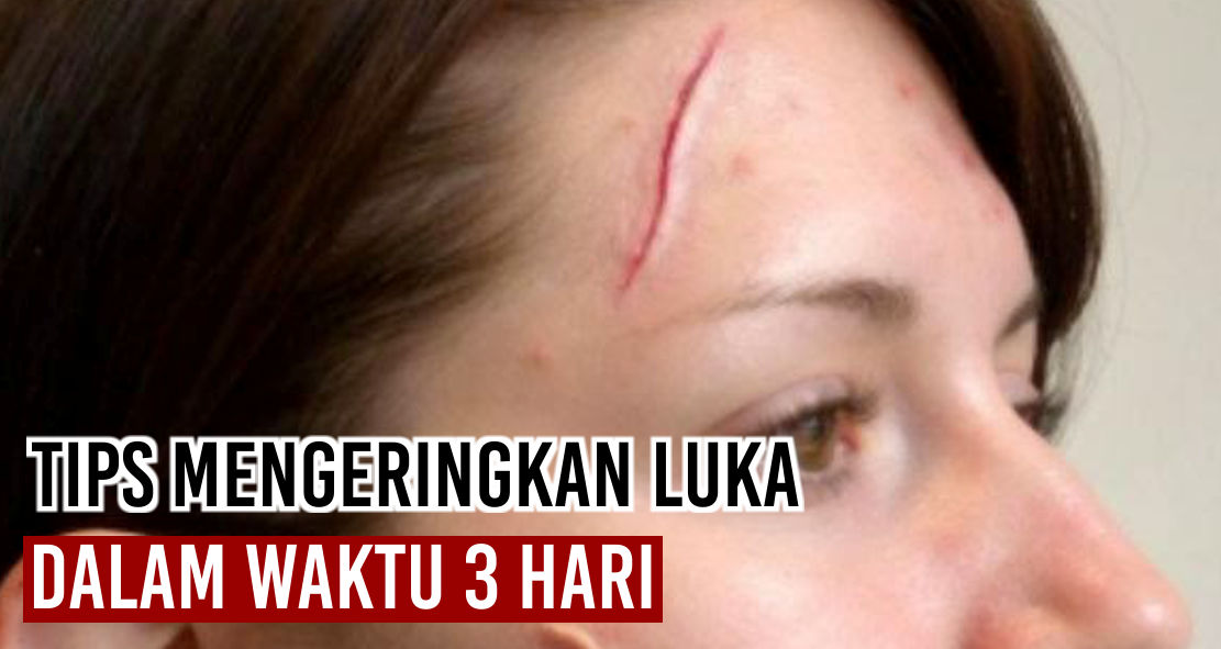 Tips Ampuh Mengeringkan Luka Dalam 3 Hari !