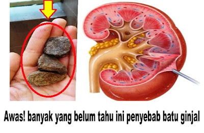 Awas! banyak yang belum tahu ini penyebab batu ginjal 
