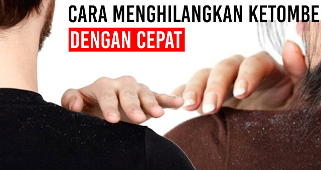 cara-menghilangkan-ketombe-secara-efektif-dan-mudah