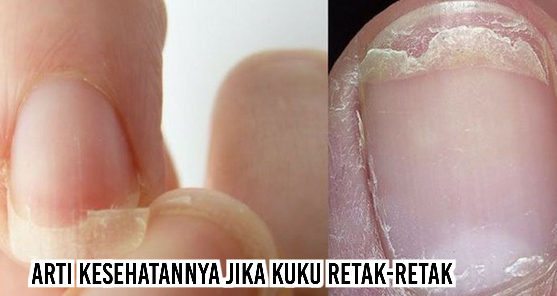 Ternyata Kamu Bisa Tahu Kesehatanmu Lewat Bentuk Dan Warna Kuku Lho !