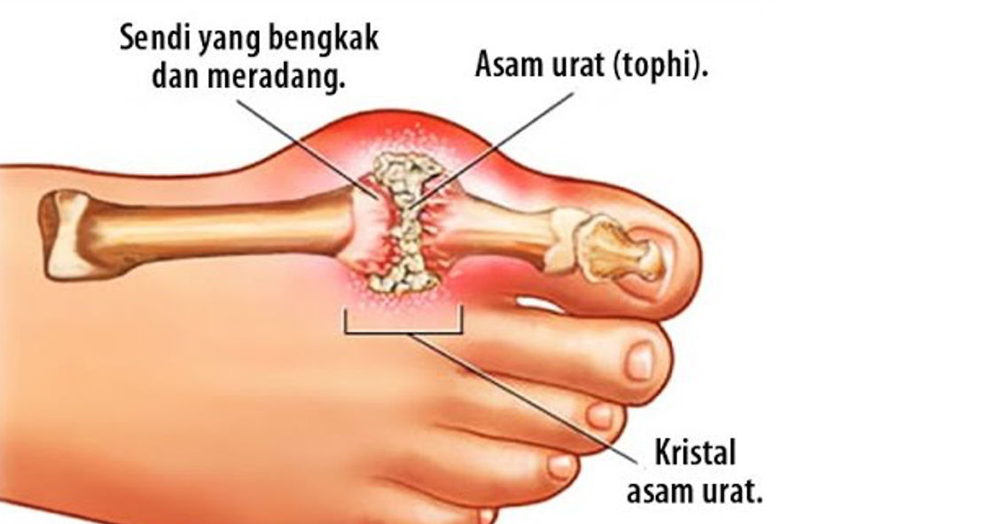  Ternyata Ini Penyebab Asam Urat Di Usia Muda !