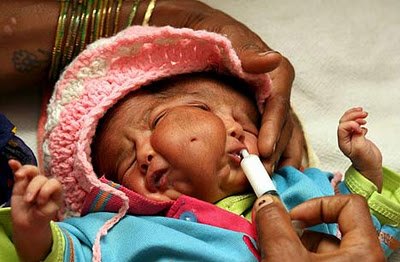 Bayi Bermata 4 Dan Berkepala 2 Dari India, Kasian Gan&#91;PIC&#93;