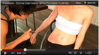Video Hot TOP Model Autralia Kampanye Psoriasis dengan Bikini