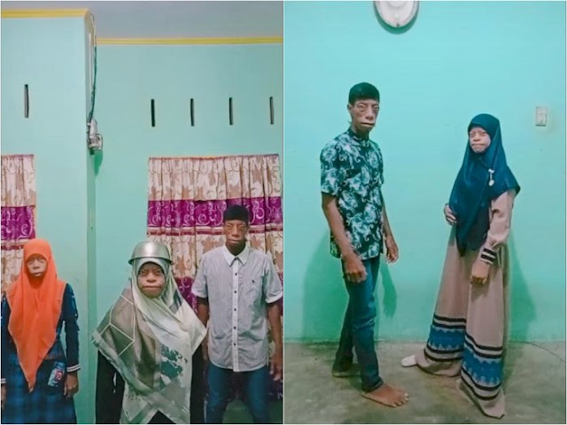 Satu Keluarga ini Tak Malu Meski Idap Sindrom Langka: Kami Bersyukur