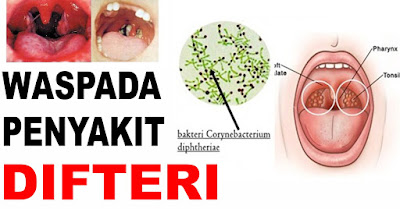 Waspada Wabah Difteri! Simak Langkah Awal Pencegahannya