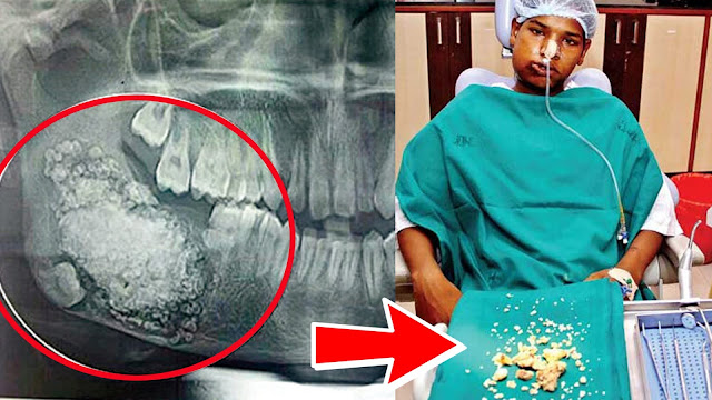 Ngeluh Sakit Gigi, Saat Diperiksa Di Dalam Giginya Terdapat Hal Mengerikan!