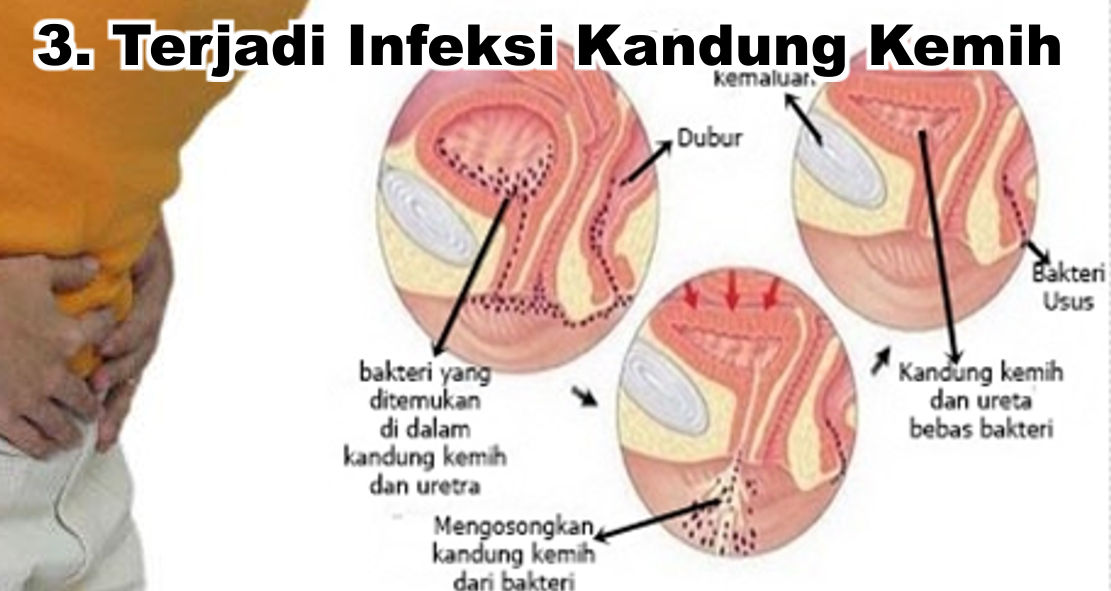  Ini Loh Bahayanya Menahan Buang Air Kecil ! 