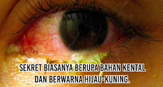 Sakit Mata Menular Lewat Pandangan, Mitos atau Fakta?