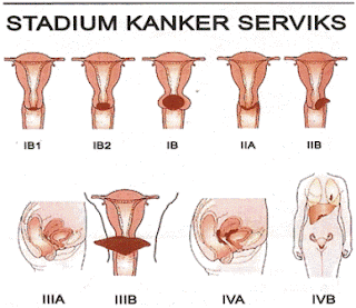 ciri-ciri-kanker-serviks-dan-penyebabnya