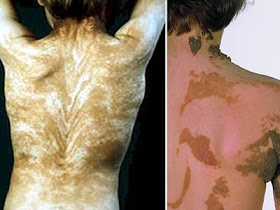 penyakit langka yang ada didunia..... tarraaaaa.......