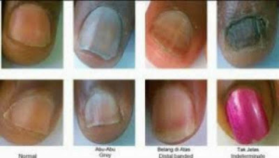Ternyata, Bentuk Dan Warna Kuku MENUNJUKKAN KESEHATANMU