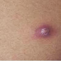 cara-sederhana--mudah-mengobati-penyakit-bisul-dgn-obat-herbal-alami