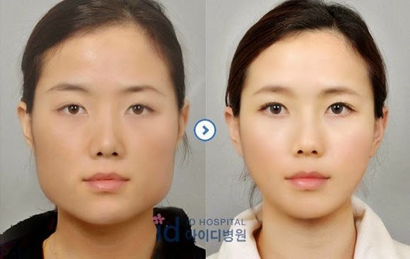 61 Contoh Foto Operasi Plastik Orang Korea 