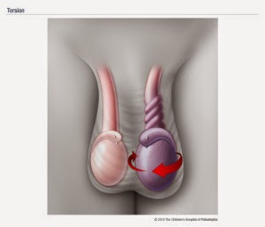 TorsioTestis, Penyakit Berbahaya Yang Bikin Temen2 Agan Ketawa