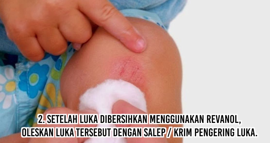 Tips Ampuh Mengeringkan Luka Dalam 3 Hari ! 