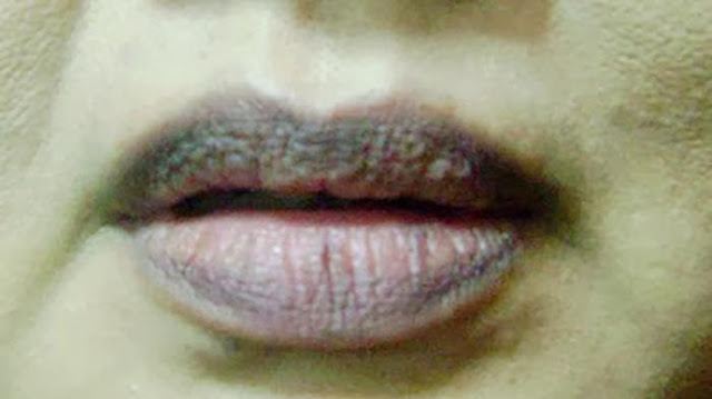 Awas! 4 Gejala pada Bibir Ini Pertanda Penyakit