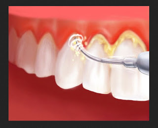 Mencegah dan Menghilangkan Karang Gigi