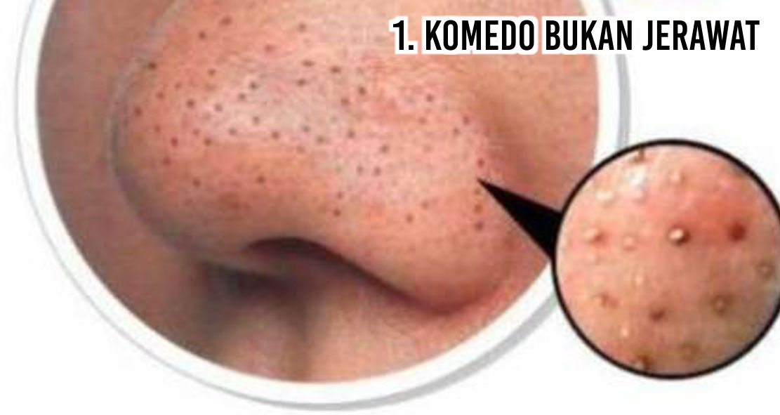 Ini Dia Fakta Tentang Komedo Yang Harus Kamu Ketahui !