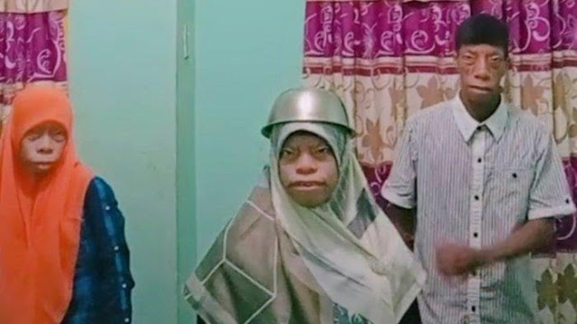 Satu Keluarga ini Tak Malu Meski Idap Sindrom Langka: Kami Bersyukur