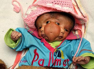 Bayi Bermata 4 Dan Berkepala 2 Dari India, Kasian Gan&#91;PIC&#93;
