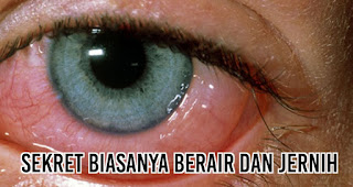 Sakit Mata Menular Lewat Pandangan, Mitos atau Fakta?