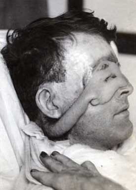 Orang Pertama yang Melakukan Operasi Plastik Di Dunia