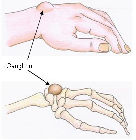 Ganglion (benjolan pada pergelangan tangan)