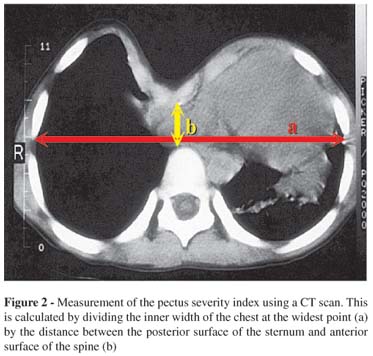 Mengenal Pectus Excavatum (penyakit dada cekung)