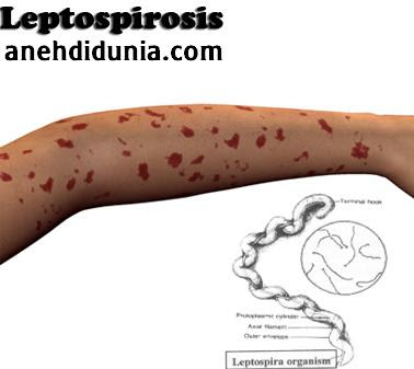&#91; HOT INFO..!!!! &#93;Bahaya Penyakit Leptospirosis Akibat Banjir