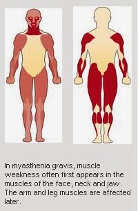 Mengenal Myasthenia Gravis, Penyakit Langka !!!