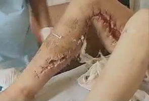 Krokodil buat manusia jadi zombie, lebih parah dari HIV/AIDS &#91;no hoakz&#93;