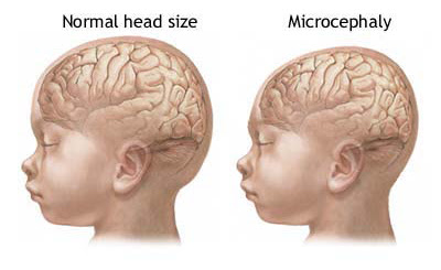 ~ Kepala Anak Microcephalus Mengecil Karena Evolusi Otak ~