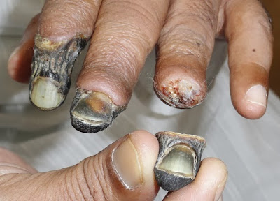 EFEK PEMAKAI HEROIN YANG MENYEBABKAN PEMBUSUKAN
