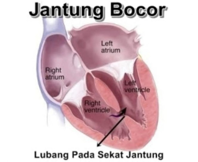 Penyakit Jantung Bocor, Bagaimana Solusi Mengobati dan Biayanya ?
