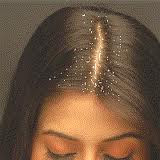 Cara Mengatasi Rambut Berketombe (maaf kalo repost)