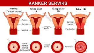 apa-itu-kanker-serviks