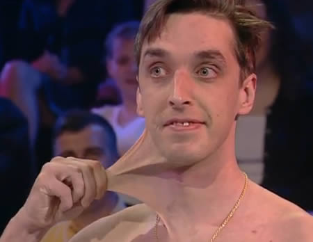 7 Penyakit Paling Aneh di Dunia, Masuk gan !