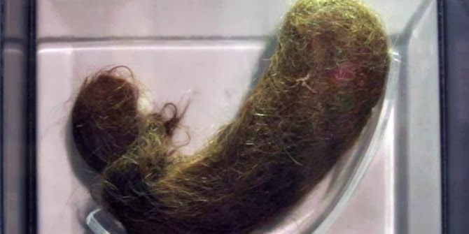  Aneh, di Dalam Perut Wanita Ini di Temukan Rambut yang Besar