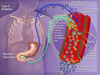 diabetes-tipe-2-bahaya-penyebab-dan-pencegahannya