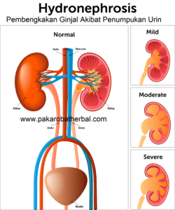 Awas! Bahaya Menahan buang air kecil 