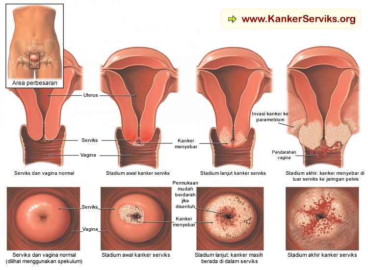 Cara Mendeteksi Beberapa Penyakit Kanker Yang Mematikan