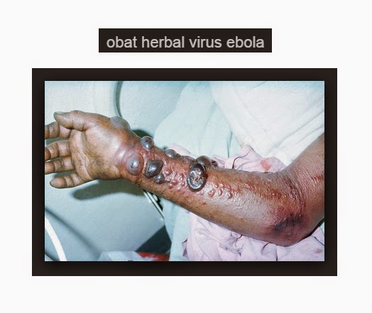 cara-mengobati-virus-ebola