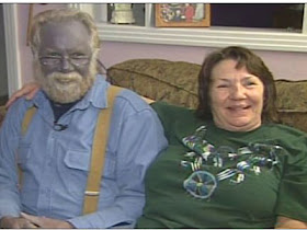 penyakit langka yang ada didunia..... tarraaaaa.......