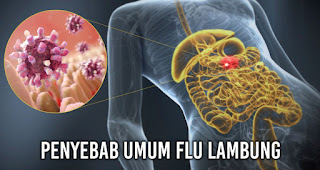 Flu Lambung, Penyakit yang jarang Diketahui Banyak Orang!