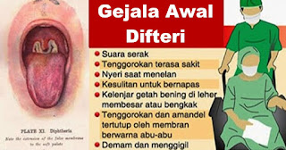 Waspada Wabah Difteri! Simak Langkah Awal Pencegahannya